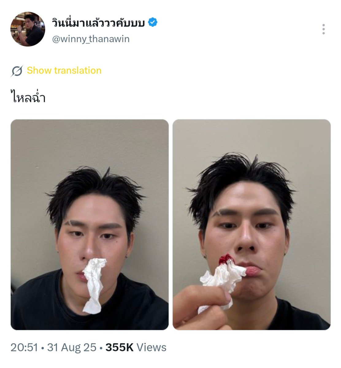 BEARWWINNY's tweet photo. one thing that never changes: being winny’s fan means you’ll also become his mom, his caretaker, his 911, and his one-call-away person, because this boy always has something unexpected happening in his life and makes sure to include us so we can witness it together in real time 😂

3 years of loving this man, and there hasn’t been a single freaking day when i haven’t worried about his clumsy ass and wanted to protect him at all costs 😭

but that’s what makes it so comforting to stan him. because although winny is rarely active on social media, and although he’s not that good at communicating with us online, he always has his own way of showing his fans that he’s not going anywhere—that he loves and treasures us with all his heart. that’s just how he is. that’s just winny’s love language 💛

#winynny @winny_thanawin