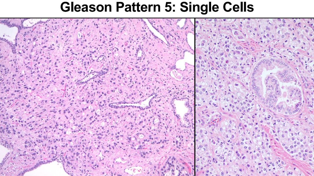 Janiranavarro's tweet photo. Gleason pattern 5-Single cells
This pattern is overdiagnosed

If you call it, the field should look like lobular breast cancer: a sheet of discohesive single cells
Do not pick out isolated cells sitting between individual glands

Dr. McKenney. Prostatic Adenocarcinoma Grading: 2026 Update #USCAP #PathX #pathology