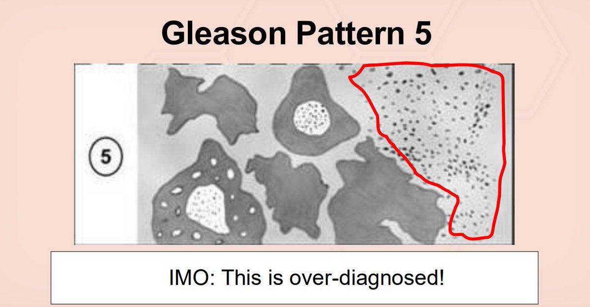 Janiranavarro's tweet photo. Gleason pattern 5-Single cells
This pattern is overdiagnosed

If you call it, the field should look like lobular breast cancer: a sheet of discohesive single cells
Do not pick out isolated cells sitting between individual glands

Dr. McKenney. Prostatic Adenocarcinoma Grading: 2026 Update #USCAP #PathX #pathology