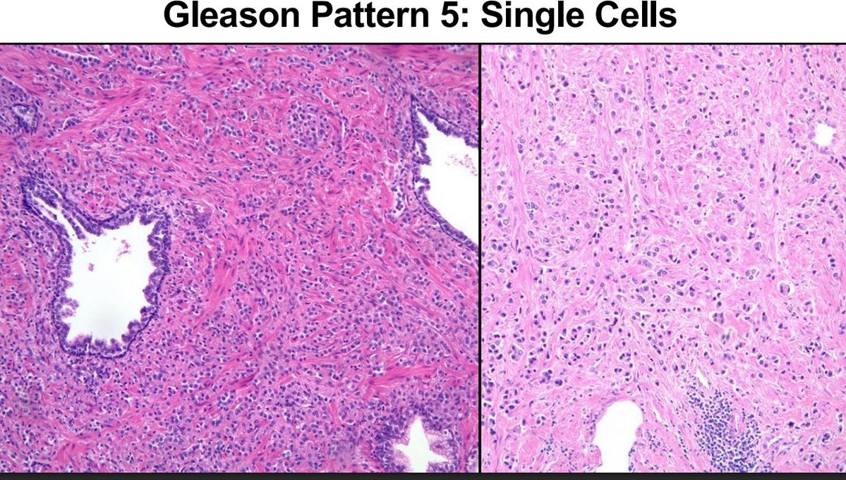 Janiranavarro's tweet photo. Gleason pattern 5-Single cells
This pattern is overdiagnosed

If you call it, the field should look like lobular breast cancer: a sheet of discohesive single cells
Do not pick out isolated cells sitting between individual glands

Dr. McKenney. Prostatic Adenocarcinoma Grading: 2026 Update #USCAP #PathX #pathology