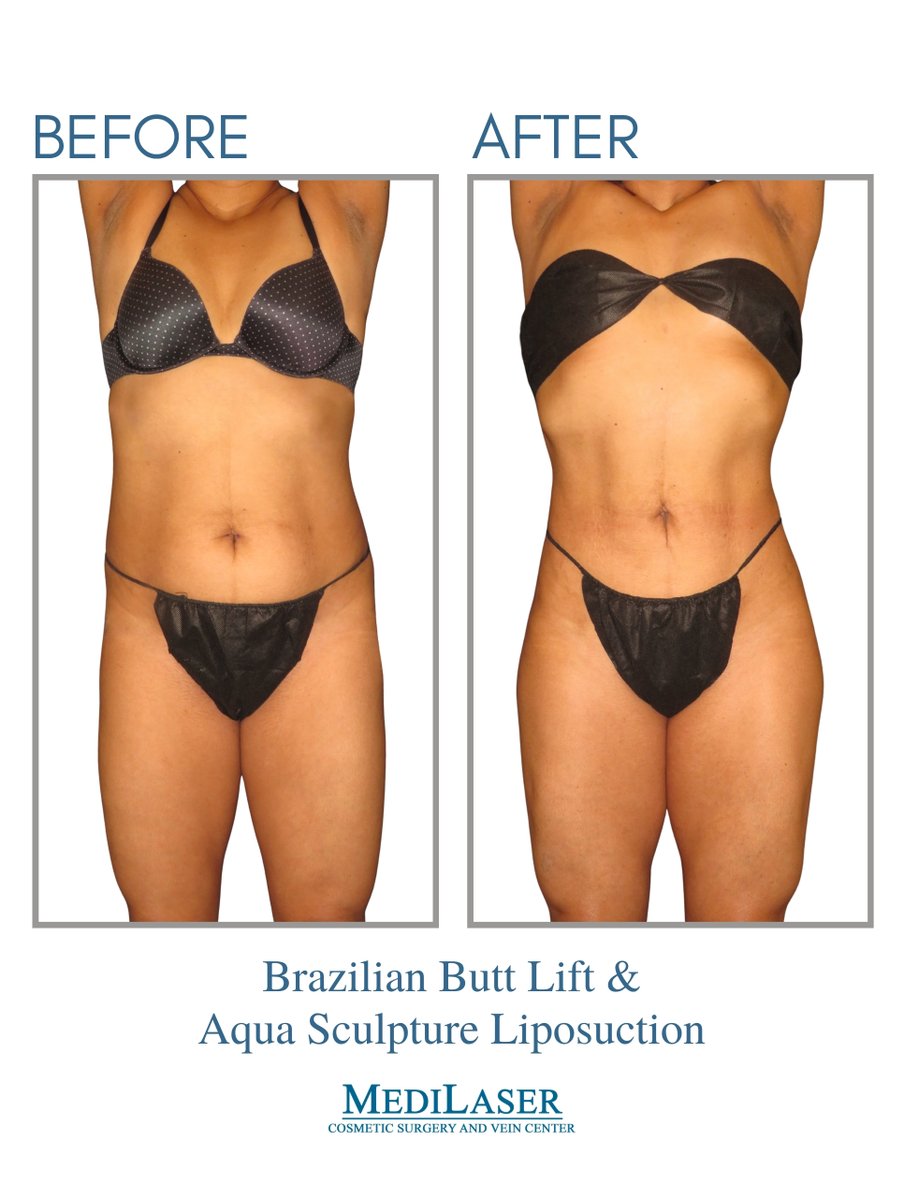 MediLaserFrisco's tweet photo. 🍑✨ Before & After Transformation! ✨🍑
📲 aBook your consultation at Medilaser today! https://t.co/t0IfzUJ7u4
#BBL #Liposuction #BodyGoals #BeforeAndAfter #MedSpa #Medilaser #Frisco #Texas #NaturalCurves #ConfidenceBoost #SummerReady https://t.co/hkqeUcUvdh
