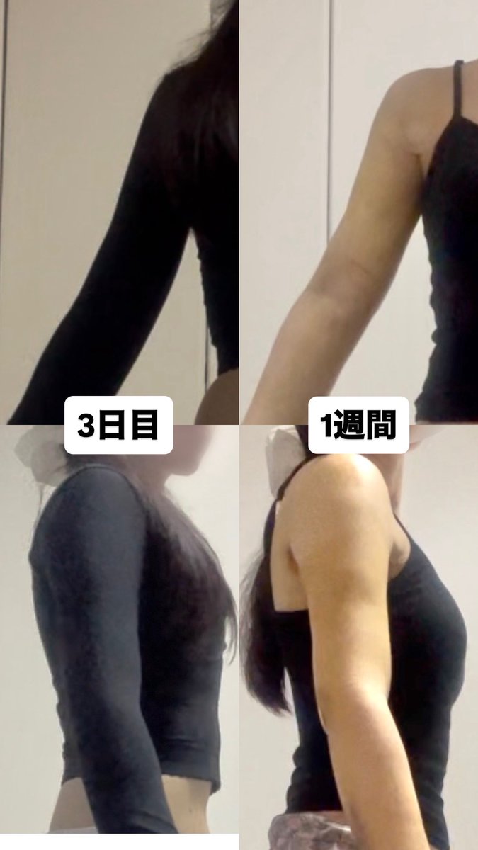 mumechumu's tweet photo. もちろん直後から細くなってて感動しましたが、3日目が腫れのピークだったのでやっと少しずつより細くなってきた実感が湧いています。これからインディバに通うので楽しみです！ https://t.co/AEgmRuWM7I