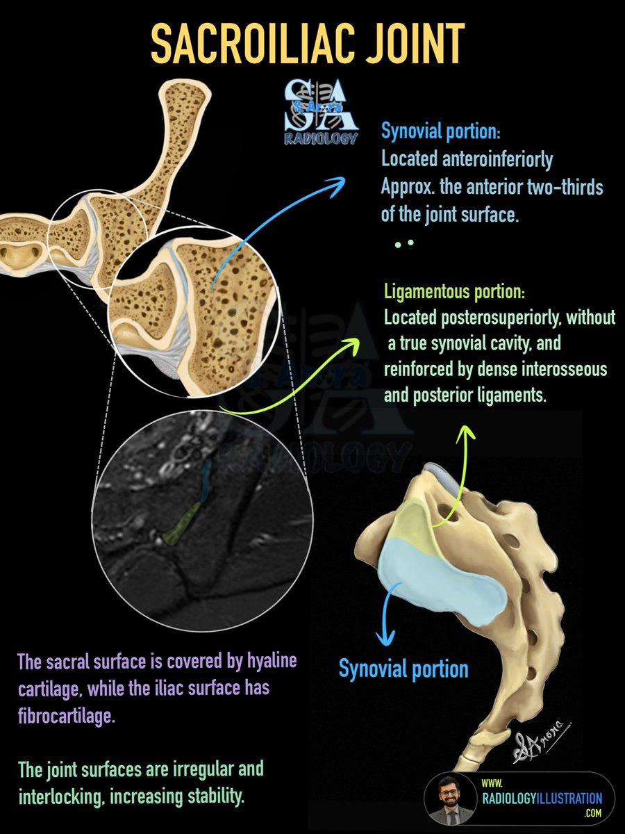 Dr_S_Arora's tweet photo. Slides on Sacroiliac joint anatomy and radiological findings of Sacroilitis on MRI. 

https://t.co/55BpiZksxa

#radiology https://t.co/uPsklQmfQU