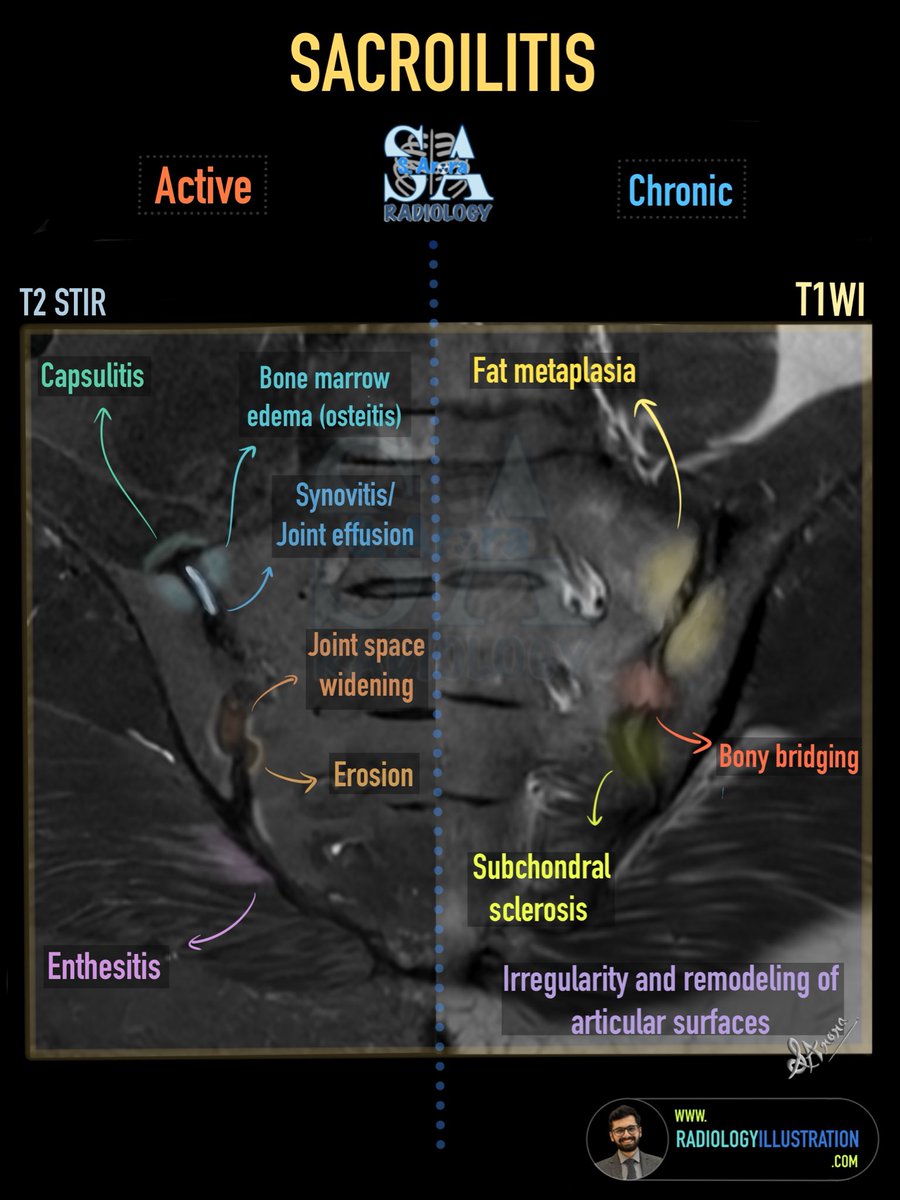 Dr_S_Arora's tweet photo. Slides on Sacroiliac joint anatomy and radiological findings of Sacroilitis on MRI. 

https://t.co/55BpiZksxa

#radiology https://t.co/uPsklQmfQU