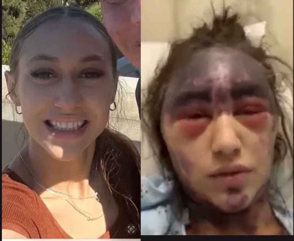 DeepLeaksHQ's tweet photo. This is what 23-year-old Alexis Lorenze looked like before her vaccine injury. And this is what she looks like now.

Alexis was mandated to take three vaccines against her will, and now she anticipates only having a few days to live. Her dying wish is for you to share her story. https://t.co/5yacGeRaMY
