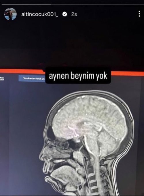 sorgutvcomm's tweet photo. Altın Çocuk olarak bilinen Ahmet Sinci, çekildiği MR’ın görüntüsünü paylaştı. https://t.co/QO2t6Ejbtr