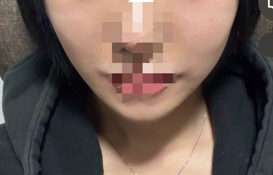 Eemmiii_io's tweet photo. 16日目！
俺ってこんなに輪郭綺麗やったんや‼️って感じ
まだ突っ張り感は多少あり https://t.co/AaDTRAwy68