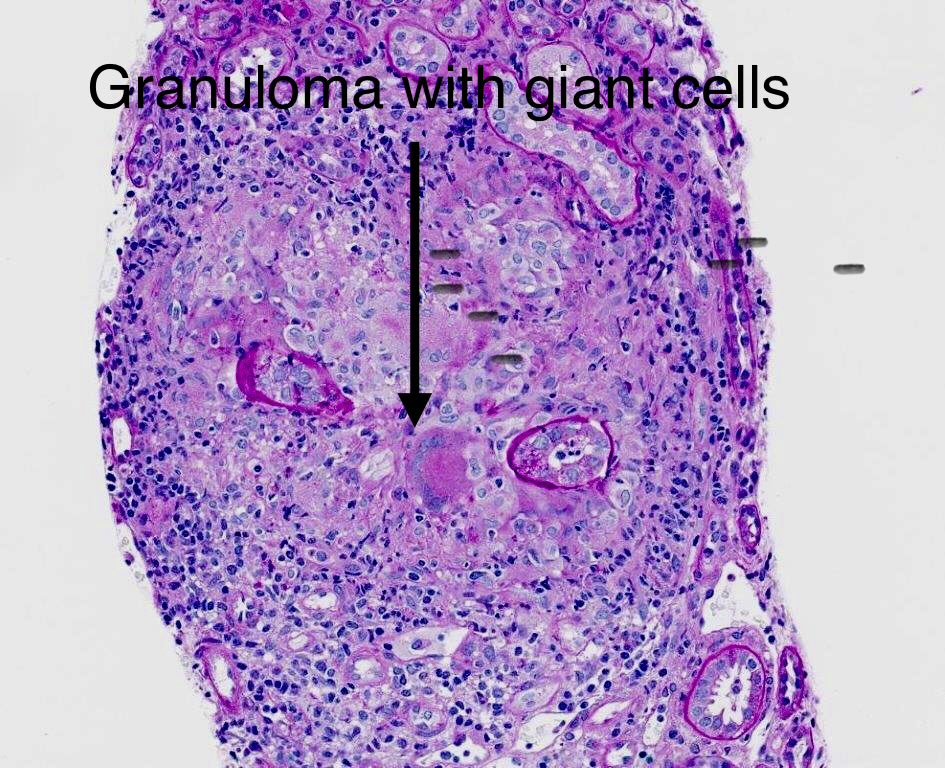 SethiRenalPath's tweet photo. At first I thought it was a straightforward drug associated interstitial nephritis with a lot of granulomas. 
The more we looked we found a few necrotizing lesions and even a small crescent. https://t.co/cdQdRuydGr