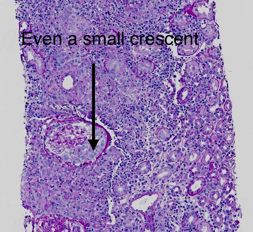 SethiRenalPath's tweet photo. At first I thought it was a straightforward drug associated interstitial nephritis with a lot of granulomas. 
The more we looked we found a few necrotizing lesions and even a small crescent. https://t.co/cdQdRuydGr
