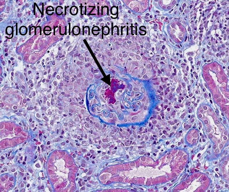 SethiRenalPath's tweet photo. Tough case. 

LM: granulomatous interstitial nephritis, extensive. 
IF: negative. 

Look carefully and you start seeing small foci of necrosis in glomeruli, surrounded by inflammation/rupture of Bowman’s capsule. 

Dx: 1. Granulomatous interstitial nephritis. 2. Necrotizing glomerulonephritis, pauci-immune. (both possibly drug related). 

30-yr woman with rash, serum creatinine 10, bipolar disorder-just started treatment. ANCA, other serology negative.
