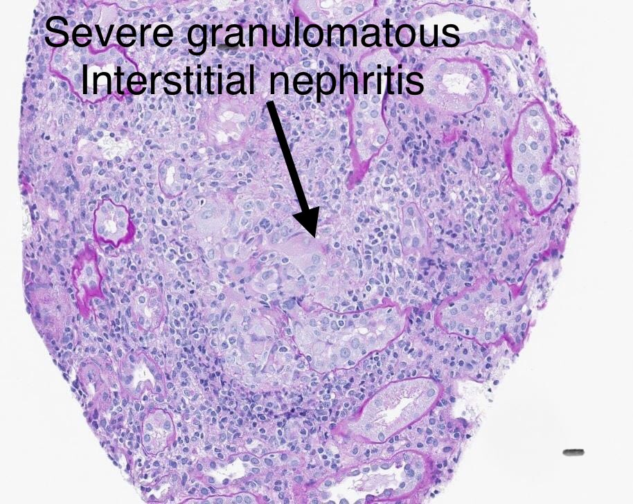 SethiRenalPath's tweet photo. Tough case. 

LM: granulomatous interstitial nephritis, extensive. 
IF: negative. 

Look carefully and you start seeing small foci of necrosis in glomeruli, surrounded by inflammation/rupture of Bowman’s capsule. 

Dx: 1. Granulomatous interstitial nephritis. 2. Necrotizing glomerulonephritis, pauci-immune. (both possibly drug related). 

30-yr woman with rash, serum creatinine 10, bipolar disorder-just started treatment. ANCA, other serology negative.