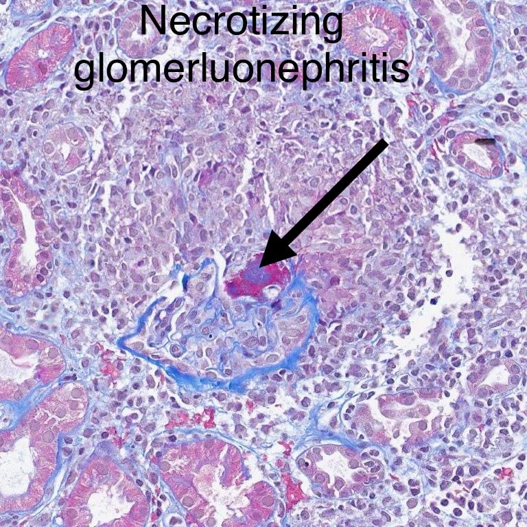 SethiRenalPath's tweet photo. Tough case. 

LM: granulomatous interstitial nephritis, extensive. 
IF: negative. 

Look carefully and you start seeing small foci of necrosis in glomeruli, surrounded by inflammation/rupture of Bowman’s capsule. 

Dx: 1. Granulomatous interstitial nephritis. 2. Necrotizing glomerulonephritis, pauci-immune. (both possibly drug related). 

30-yr woman with rash, serum creatinine 10, bipolar disorder-just started treatment. ANCA, other serology negative.