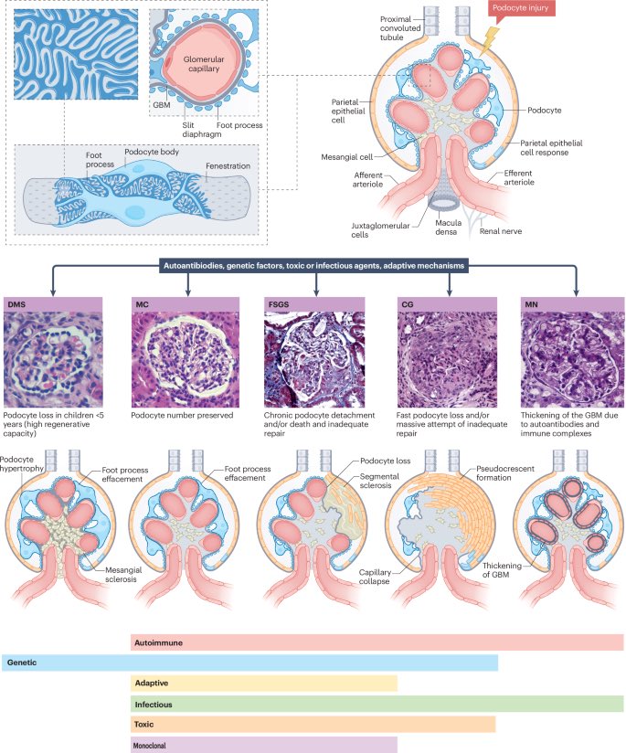edgarvlermamd's tweet photo. Current advances in the field and their effects on diagnostic and therapeutic algorithms open the path towards personalized use of traditional treatments and newly available drugs, which should improve outcomes and quality of life for patients with #podocytopathies (from lecture of @Tobias_B_Huber)
#Nephpearls #RKDSummit 

👉🏼 https://t.co/lgiyci2N6B