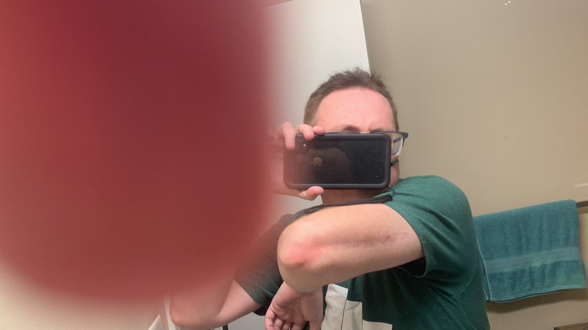 TomManson0rtq's tweet photo. @LeEpicBooch @CarcinogenLG @GETBrainTrust @Boxy_FT Also got lucky twice but almost a double amputee too. Still walked in person to show mine in 2020(that's how little I trust our government.) https://t.co/TUwRQwlFe1