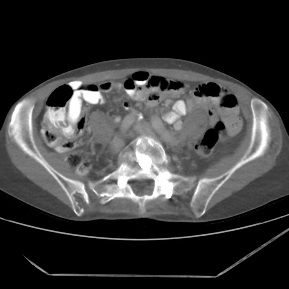 danatsouza's tweet photo. This is not an osseous metastasis!

Iliac bone graft harvesting! Most frequent autograft donor site: superficial, accessible, provides abundant bone... 

@MGBRadEdu @FOAMrad @SAR_RFS @futureradres @ARRS_Radiology @Abdominal_Rad @CBRadiologia @DanaFarber #MedEd https://t.co/OyuglsnFhV