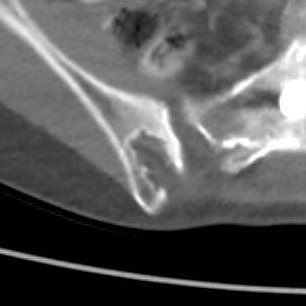 danatsouza's tweet photo. This is not an osseous metastasis!

Iliac bone graft harvesting! Most frequent autograft donor site: superficial, accessible, provides abundant bone... 

@MGBRadEdu @FOAMrad @SAR_RFS @futureradres @ARRS_Radiology @Abdominal_Rad @CBRadiologia @DanaFarber #MedEd https://t.co/OyuglsnFhV