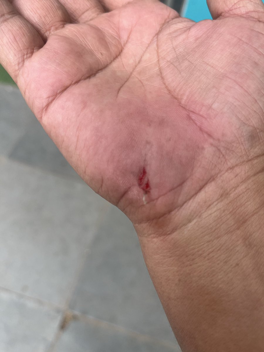 letlal's tweet photo. HELMET SAVED ME TODAY 🙏

Today, I took an Uber Bike and met with an accident. The bike slipped and both of us were saved because we were wearing helmets. Please wear a helmet. It’s not just a rule it can truly save your life. https://t.co/PRlxxPI6VK