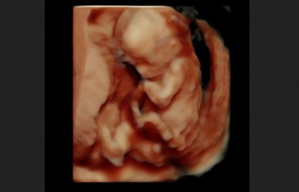LifeNewsToo's tweet photo. This is an unborn baby at 15 weeks. 

A human being with a right to life. https://t.co/wIO9Bjh3Vo