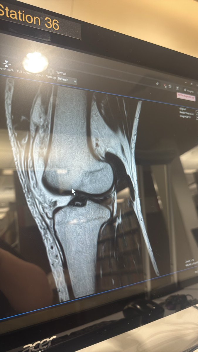 hipp3don's tweet photo. I completely tore one of the knee’s major stabilizing ropes (ACL), tore BOTH shock-absorbing pads (menisci), displaced part of one of those tears, bruised the bone where my weight travels through the knee, and accumulated a bunch of fluid inside the joint https://t.co/JGUGBFFYuu