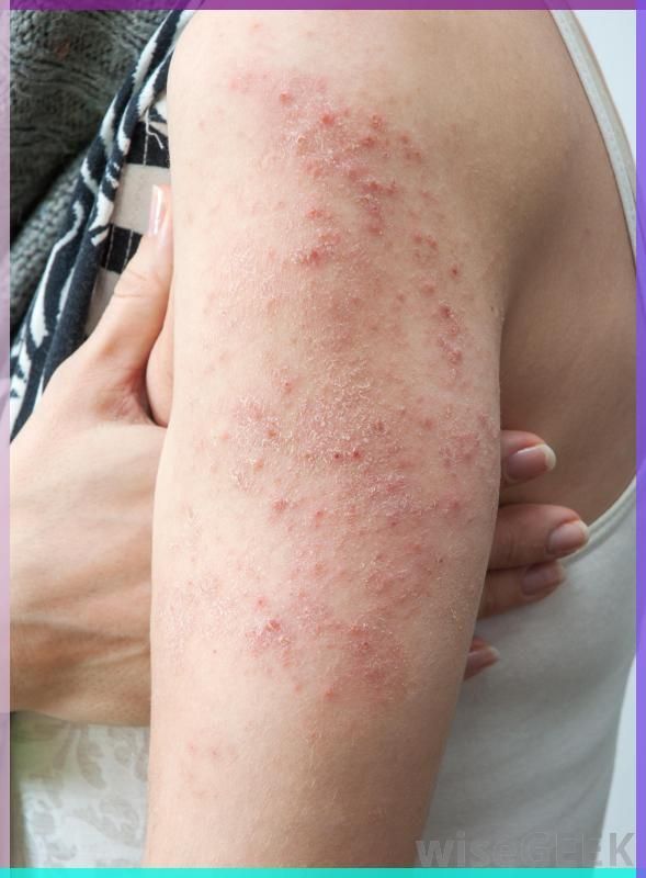 YosuepEstebanX's tweet photo. INFECCIONES DE TRANSMISIÓN SEXUAL 

1. VIRUS DEL PAPILOMA HUMANO https://t.co/y2TUlvI3bc
