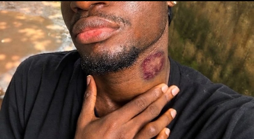 zardgr8's tweet photo. It’s been more than 2 weeks since I got this hickey, but it doesn’t seem to be healing, and it’s still painful. Should I be worried?😭 https://t.co/cUA88SCqb4