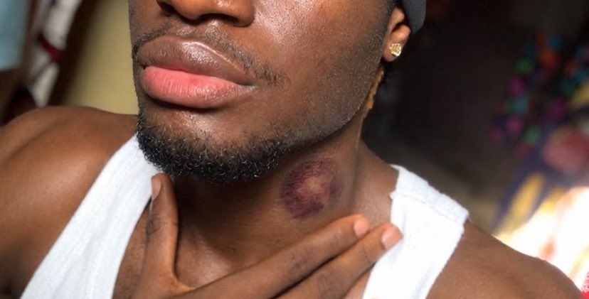 zardgr8's tweet photo. It’s been more than 2 weeks since I got this hickey, but it doesn’t seem to be healing, and it’s still painful. Should I be worried?😭 https://t.co/cUA88SCqb4