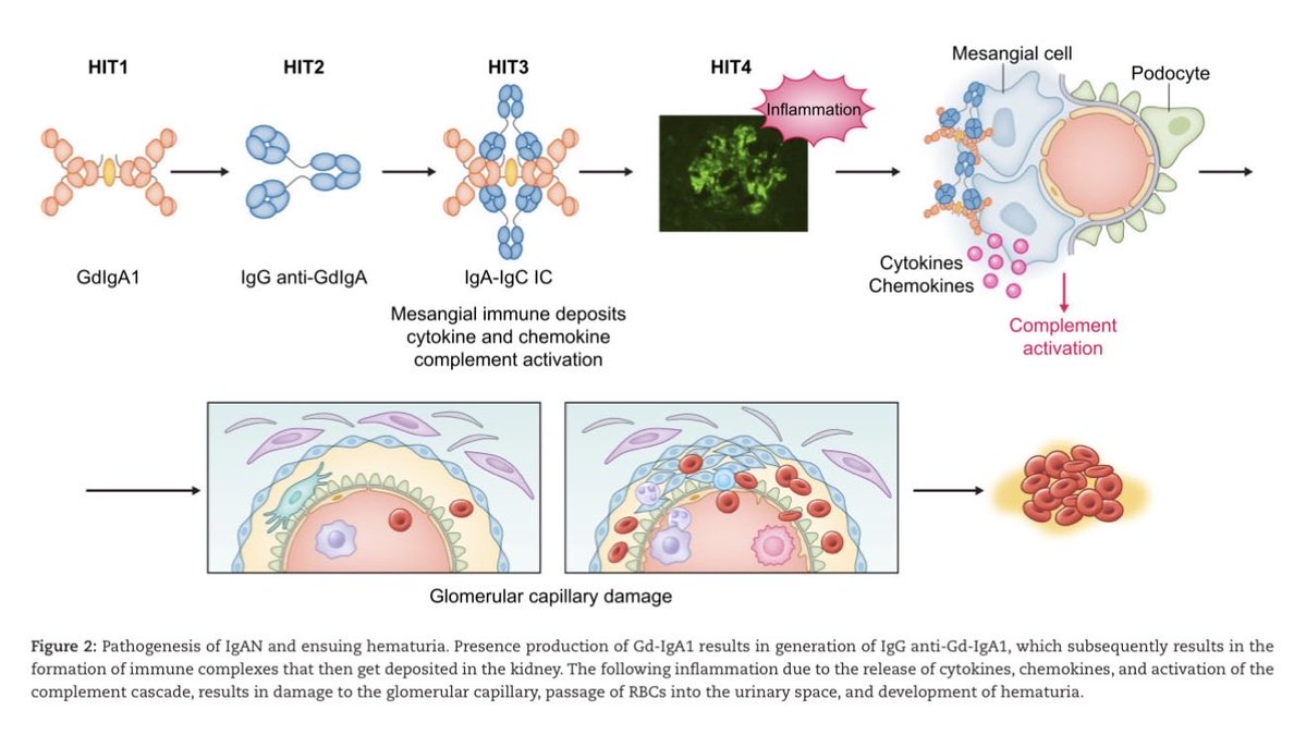 edgarvlermamd's tweet photo. Microscopic hematuria as a risk factor for #IgAN progression: considering this biomarker in selecting and monitoring patients ca. 2023 from @LadanZand @fervenzaf
#Nephpearls #RKDSummit
๐๐ผ https://t.co/2uWJ8miYNV https://t.co/8BL716xvsf