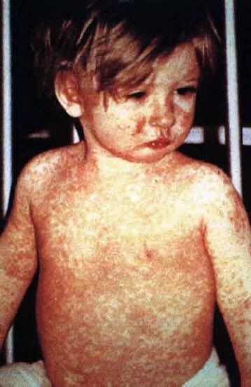 DrNeilStone's tweet photo. "Natural immunity" to measles comes with a risk of pneumonia, encephalitis, blindness, and a rare fatal brain disease that can appear years later. 

The vaccine gives you the immunity without any of that. https://t.co/kruEKeIiyH