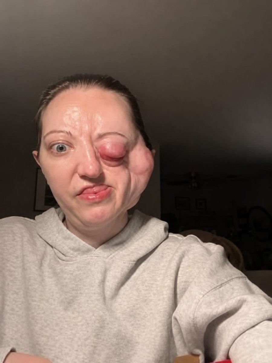 Natalie9c's tweet photo. 💔 My life changed forever the moment I was diagnosed with face cancer. Since then, I’ve been facing a difficult journey filled with painful treatment, uncertainty, and expenses I can no longer manage on my own. https://t.co/8XJw2x3u8W