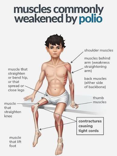 DrNeilStone's tweet photo. Parents in the 1950s closed swimming pools and kept their kids home all summer because they were scared of polio. 

Today's parents get their kids vaccinated and carry on . 

That's progress. https://t.co/kA40FmwIrh