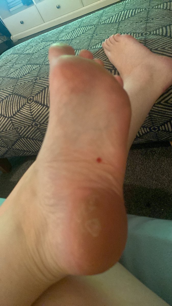 emscrustyfwt's tweet photo. Stood on the dogs bloody bone! Owch https://t.co/TvYDk3IJpw