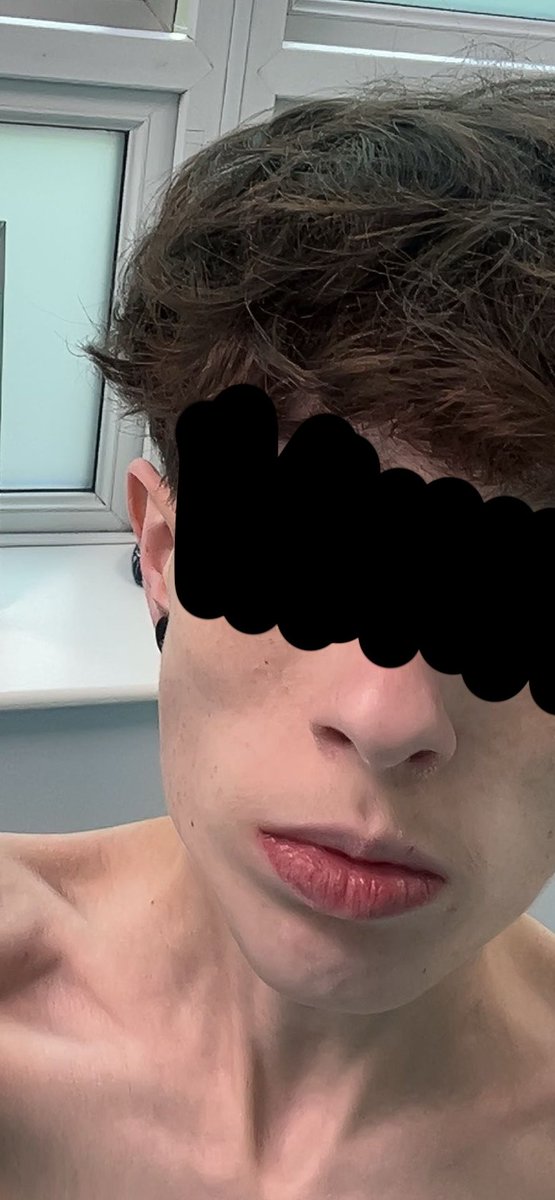 Jack_Attack0_o's tweet photo. @Igotccchronic I got rlly chubby face genetics 🫩
But even at bmi 13 I look normal just not fat…
Then at bmi 12 it just randomly all disappears 😭 https://t.co/Hb0fvtC6wB