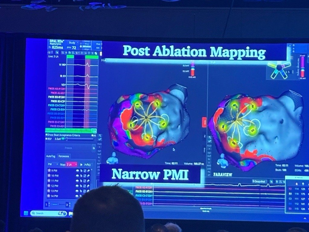 BSCCardiology's tweet photo. Advancements in AFib care begin with thoughtful questions and conversations between EPs. Attendees have come together for meaningful debate over the last few days at #TransformAF2026, sharing data, best practices, and insights to improve patient outcomes. #EPeeps
FARAPULSE™ Pulsed Field Ablation System Indications, Safety, and Warnings: https://t.co/A64fZE9GVn
OPAL™ HDx Mapping System Indications, Safety, and Warnings: https://t.co/wu777PHkBb