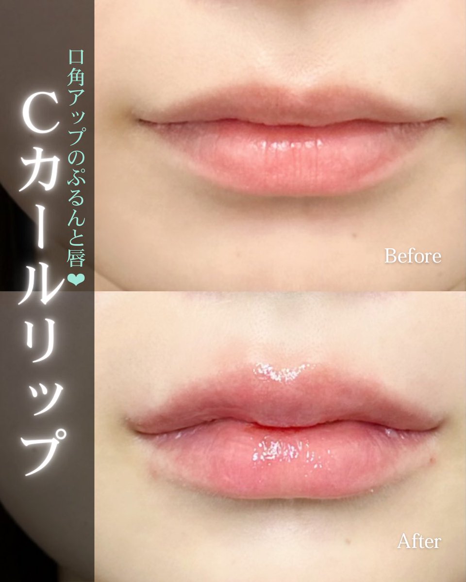 lula_sendai's tweet photo. こんにちは！
ルラ美容クリニック仙台院です🎀

Cカールリップで口角アップしたかわいい唇に🩷
ご理想に合わせて注入します💉

カウンセリング無料です！
お気軽にご相談ください🤍

#ルラ美容クリニック #ルラ美容クリニック仙台院 #プチ整形 #唇 #唇ヒアルロン酸 ＃垢ぬけ https://t.co/ECHEf8Bh3y