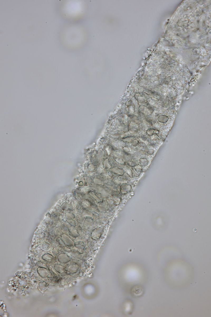 jrseltzer's tweet photo. RBC cast - brightfield, unstained, and acanthocyte with SM stain - from elderly patient with Crohn's disease and microscopic hematuria -#UrineMicroscopy #UrinarySediment https://t.co/CknHx8sjKv