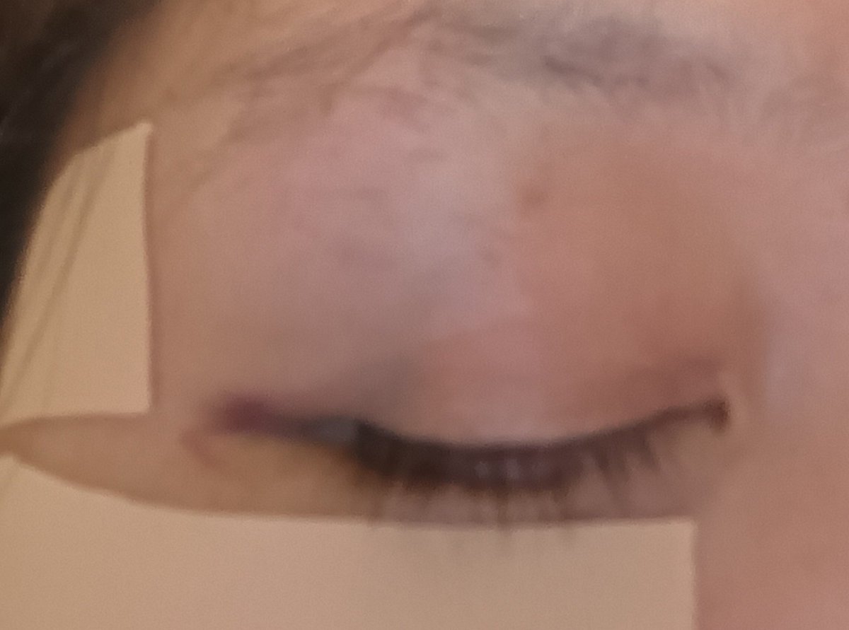 potirooo's tweet photo. おはよう御座います🐕️

腹筋ローラー？で膝コロ続けていたらだいぶ体幹しっかりしてきた感じがあったので試しに立ちコロやってみた結果、ローラー足元に一気に滑って床に顔から倒れてこんなんなりました…

頬骨もこれから青くなる見込み。

多分骨折してないけど眼帯必須になってしまいました…🐕️ https://t.co/YObZ9bYeVe
