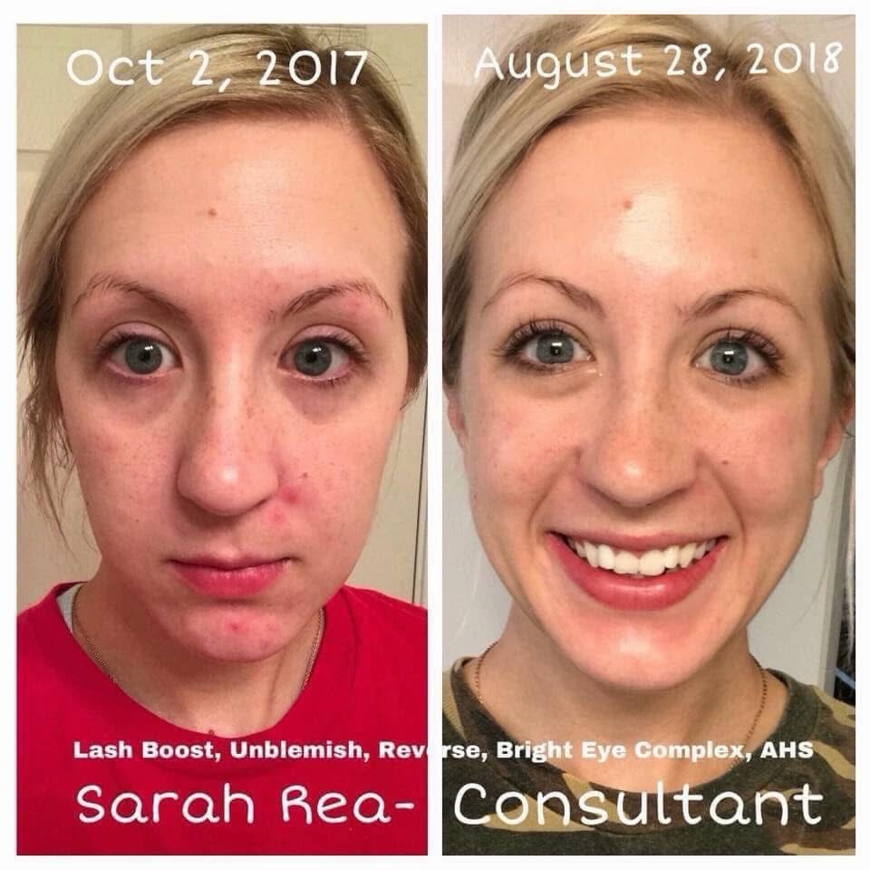 CyrusComeguooc's tweet photo. Two things: My before photo looks like a prison mugshot—I looked angry because I was sad about my skin. So embarrassing! And this wasn’t even its worst. Also, I’m wearing absolutely no makeup in the after photo. I’m smiling because I never thought https://t.co/2guaeA2roj