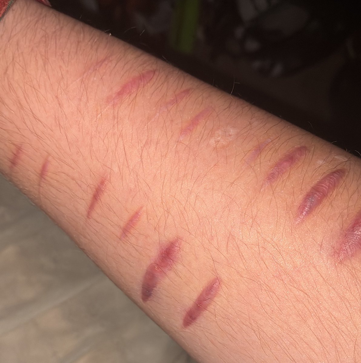 hoppindie's tweet photo. why did they scar like this??? I’m so jelly of arm cutters…. I’m under observation still 🙁

#shtwt #slittwt #988twt #slittytwt https://t.co/GLxs1knZgO