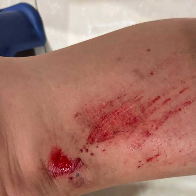 RivaProthero's tweet photo. Tonight really scared me… 😖

My husband accidentally fell off his bike on the way home from work. After he got home, I took him to the clinic to have his wounds treated. Seeing him safe finally gave me some peace of mind. 🙏

Accidents happen https://t.co/etV0SlVbcr