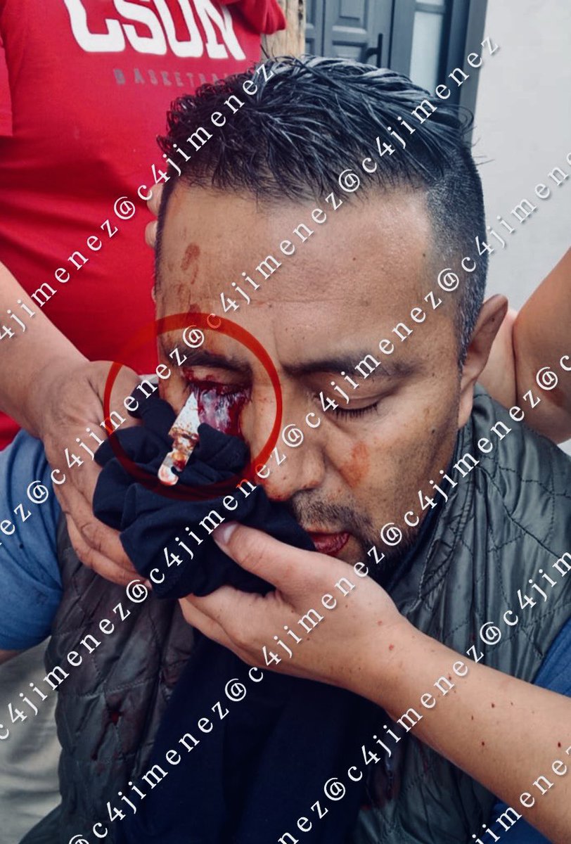 c4jimenez's tweet photo. PELEA con SUS VECINOS… y le CLAVAN un CUCHILLO en el OJO
Así acabó el ojo de Pedro Ramírez
Tuvo una riña con sus vecinos de la Col Sta Lucia en @AlcaldiaAO 
Uno de ellos tomó un cuchillo y se lo clavó así.
Agentes de @SSC_CDMX detuvieron a 2 de los agresores.
Llevaron a Pedro al hospital.