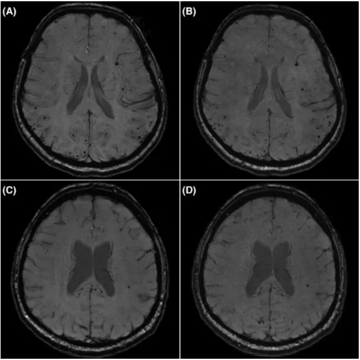 UCLGiving's tweet photo. September is #WorldAlzheimersMonth and we're spotlighting breakthrough UCL research!

UCL researchers have developed a way to cut dementia brain scan times from nearly 18 minutes down to just six and a half minutes without losing image quality. 

👉 https://t.co/WRrvtIsMQV https://t.co/ZZi4Fqk6dm