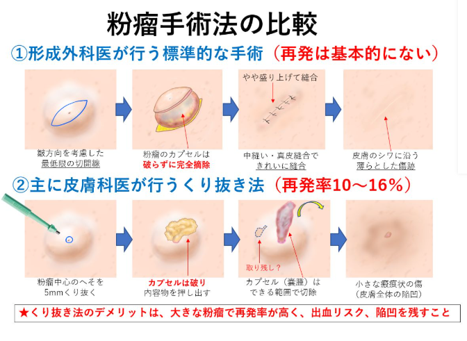 sakurai_yuka's tweet photo. これはおそらく、形成外科医による手術と
皮膚科医その他による手術との違いだなー https://t.co/9PZzNnVJfI