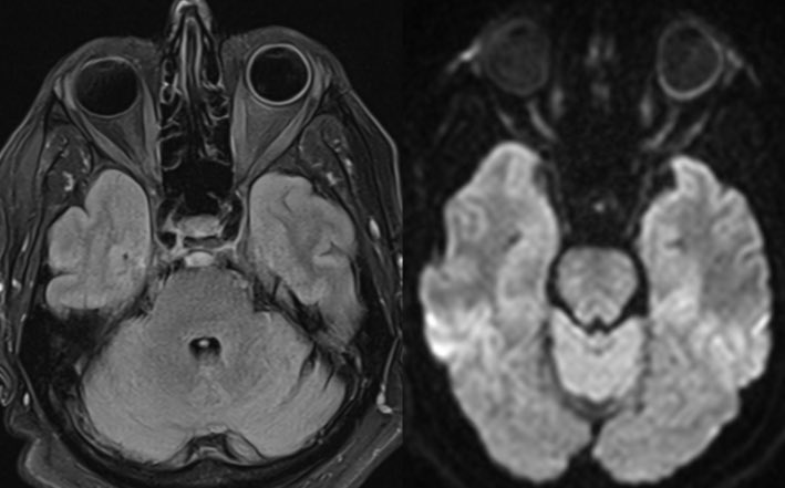 daniel_gewolb's tweet photo. ⭐️ What is the most likely diagnosis in this 65 yr old male presenting with painless progressive left eye vision loss? 👁️ 🧠
#Ophthalmology #Radres #futureradres #medicine #Neurosurgery #ENT #Neurology #MRI #FOAMed https://t.co/jWEnNEdEPj