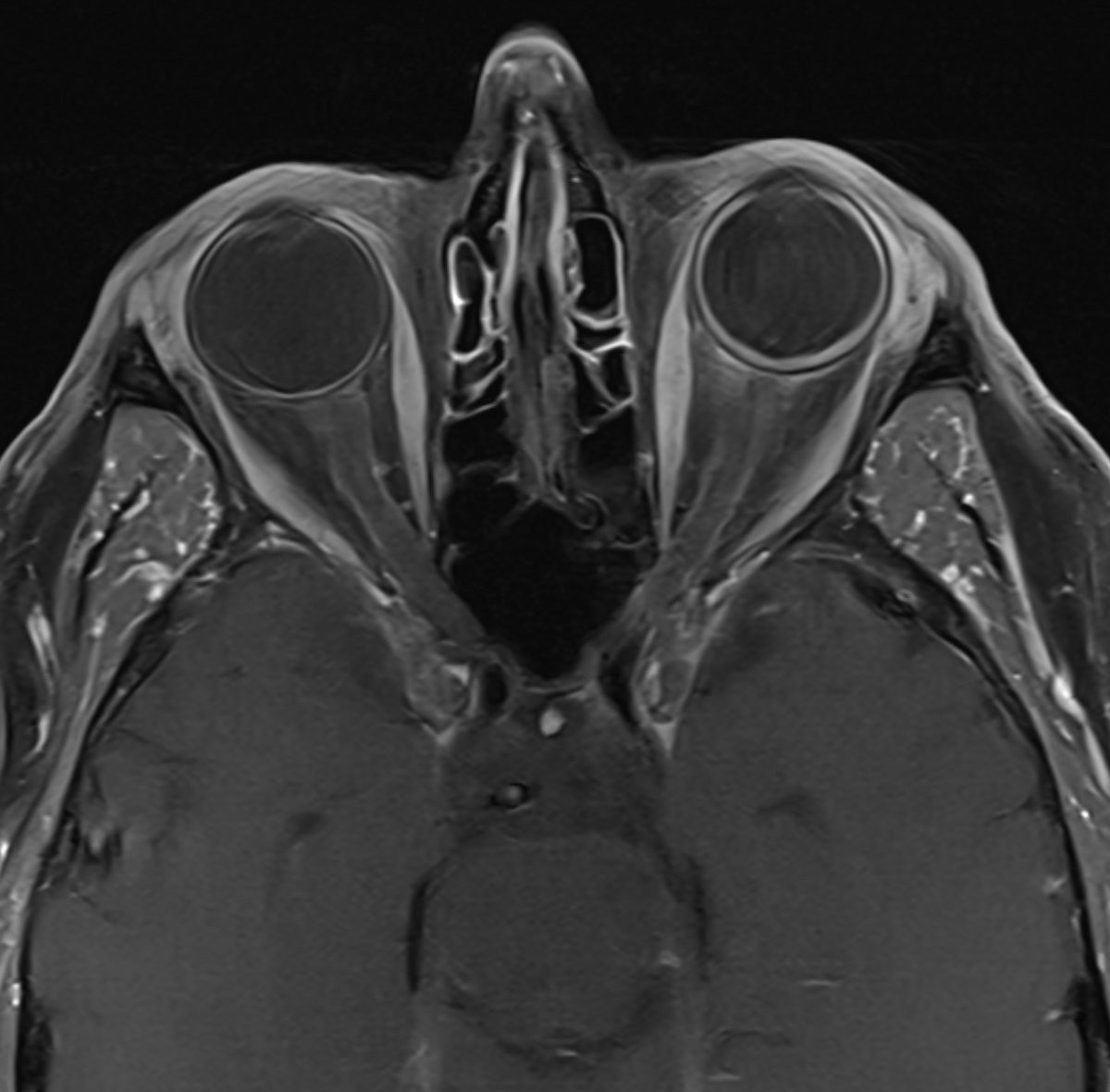 daniel_gewolb's tweet photo. ⭐️ What is the most likely diagnosis in this 65 yr old male presenting with painless progressive left eye vision loss? 👁️ 🧠
#Ophthalmology #Radres #futureradres #medicine #Neurosurgery #ENT #Neurology #MRI #FOAMed https://t.co/jWEnNEdEPj