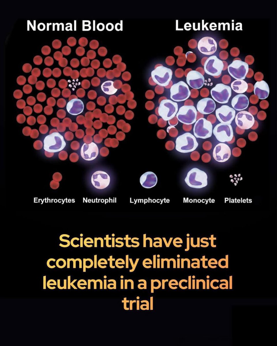 NextScience's tweet photo. 🚨 Scientists just reprogrammed leukemia to self-destruct – and it worked.

In a major breakthrough, scientists at Institut Pasteur have developed a therapy that forces leukemia cells to self-destruct—and alerts the immune system to wipe out the rest. 

The team targeted malignant B-cell leukemia with a triple-drug combination that reprograms cancer cells to undergo necroptosis, a form of inflammatory cell death. 

Unlike the silent shutdown of apoptosis, necroptosis creates an immune alarm, drawing in the body's defenses. Using real-time imaging, researchers watched immune cells swarm the cancer, leading to total tumor elimination in lab models.

The challenge was that B-cell cancers typically lack a key protein, MLKL, needed for necroptosis. But the team cleverly sidestepped this using three existing clinical drugs. Together, they bypassed the missing protein and reactivated necroptotic pathways. The result: not just tumor shrinkage, but complete disappearance in multiple preclinical models. While human trials are still to come, the findings hint at a new kind of cancer therapy—one that doesn’t just kill tumors, but trains the immune system to join the fight. And because the drugs are already approved, the road to real-world use could be much shorter.

Source: Le Cann, F., et al. Reprogramming RIPK3-induced cell death in malignant B cells promotes immune-mediated tumor control. Science Advances.