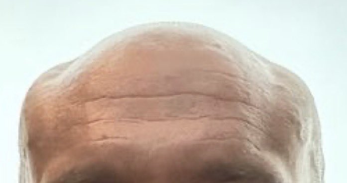 cold_and_quiet's tweet photo. Love Dr Mike and hopefully he doesn’t block me or get offended at this, but this is a good example of the kind of abnormalities that occur when you abuse growth hormones and other PEDs. 

This is not the shape your head is supposed to be https://t.co/7AzclZzvM0