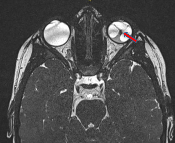 cad1em's tweet photo. persistent fetal vasculature
硝子体血管遺残、くらいが意味が通りやすいかも
胎児期に硝子体を栄養していた血管が退縮せずに残って(赤矢印)、網膜剥離や水晶体の変形、小眼球、場合によっては視神経萎縮。
片側性が多く、両側性だと遺伝性疾患などの可能性
PMID 39539385
#RdiagTips https://t.co/VKuGwIzU8C