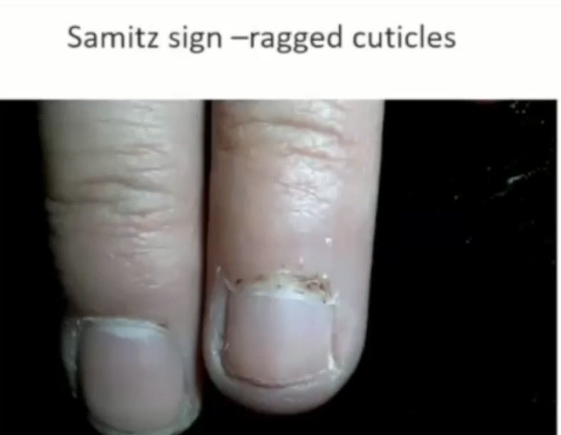 Abhilasha21822's tweet photo. Look at the knuckles! 🖐️

In Dermatomyositis, the MCP & PIP skin is involved → Gottron papules/sign.

In SLE, the knuckle areas are typically spared.

And don’t miss the nailfold clues:

🔹 Dilated capillaries
🔹 Ragged cuticles ..Samitz sign

#Dermatomyositis #SLE #Rheumatology #ClinicalPearl