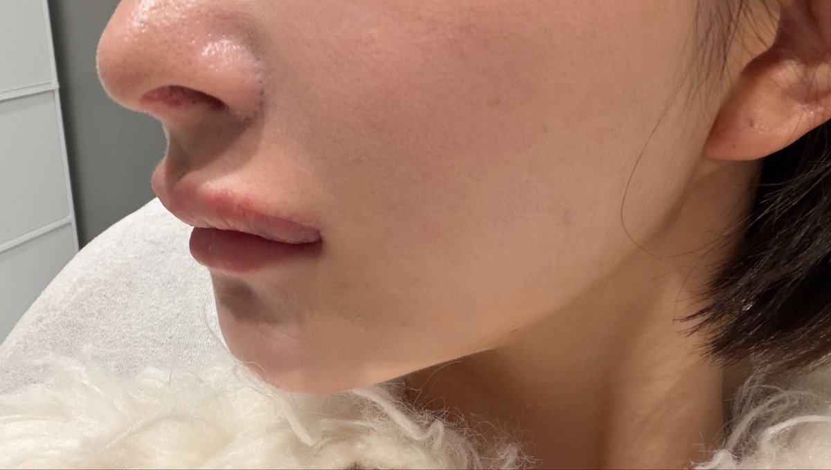 eccentricbambi's tweet photo. 今日口角挙上＋外側人中抜糸してきた。
直後でこれは綺麗すぎないか？
今の感じすごく気に入ってる。
抜糸動画の傷があまりにも綺麗だから感動して＠dr_fukuda_yasu 先生にお願いした。普通にカウセ行って。

私が直前で要望を超絶ナチュラルにしてしまったから、少し物足りなくなるかもしれないからそしたら��たリオぺ考えてるけど私は焦りすぎなので一旦経過観察する。

とにかく傷が綺麗で感動してる😭