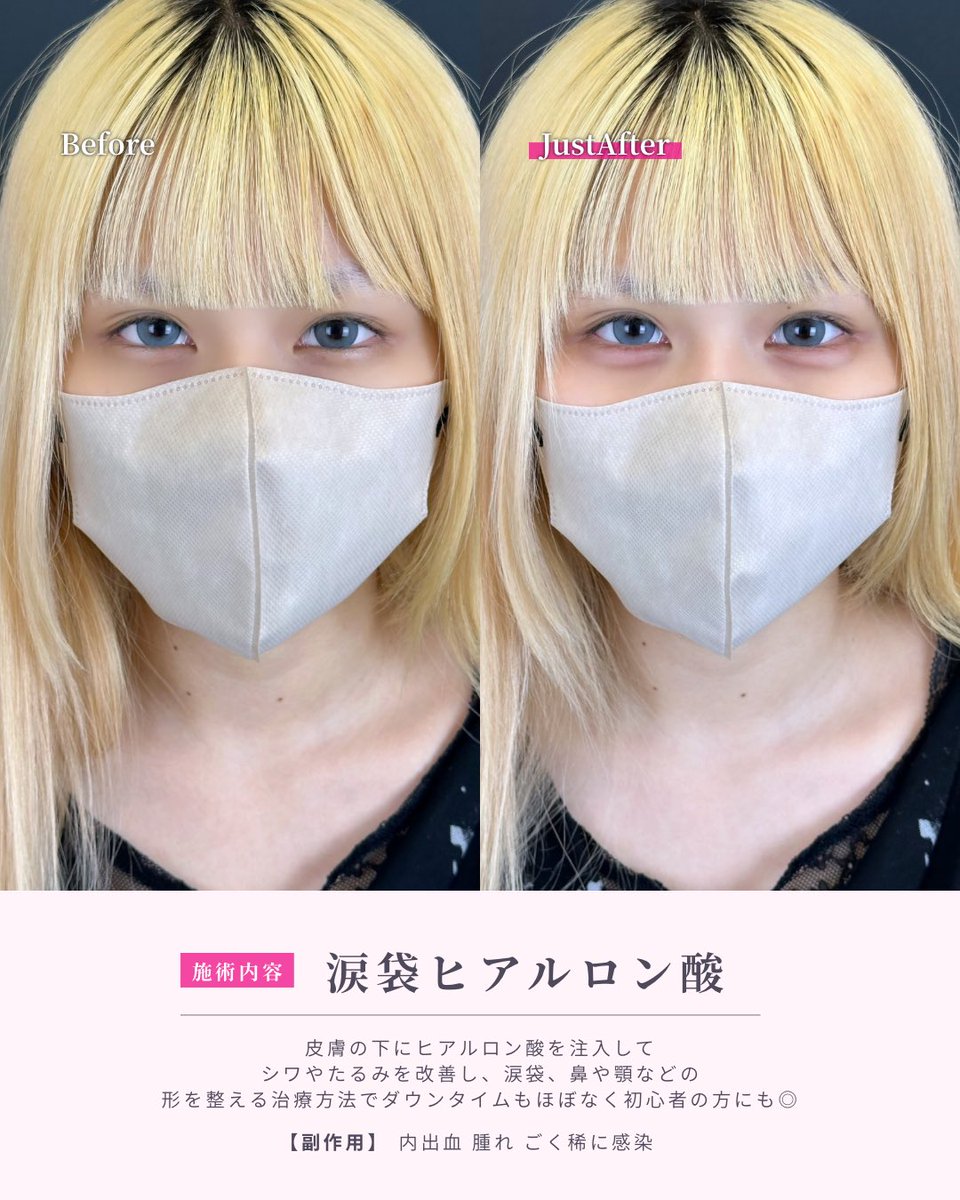 lula_hiroshima's tweet photo. うるきゅるかわいい涙袋👼🤍
年齢問わず絶大な人気の涙袋ヒアル🩵

【執刀医】角南医師🤡
 #ルラ美容クリニック https://t.co/cR5Vp1PXFX